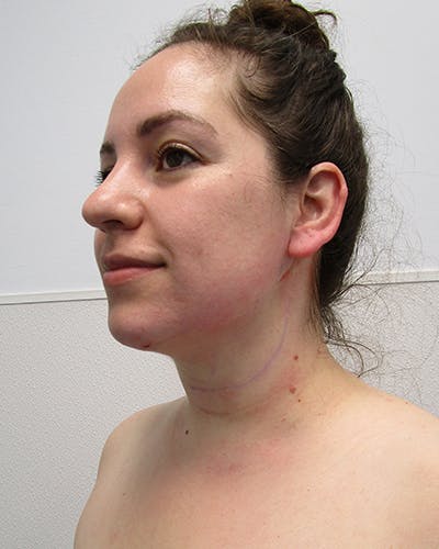 Neck Liposuction Before & After Gallery - Patient 219965 - Image 2