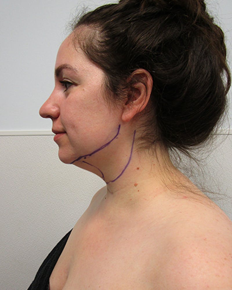 Neck Liposuction Before & After Gallery - Patient 219965 - Image 3