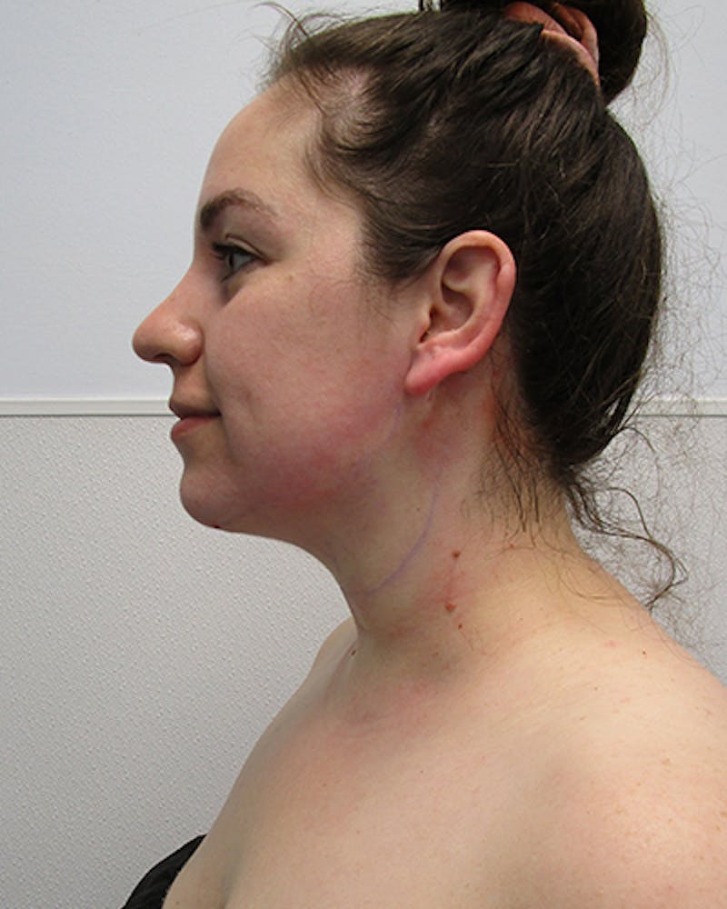 Neck Liposuction Before & After Gallery - Patient 219965 - Image 4