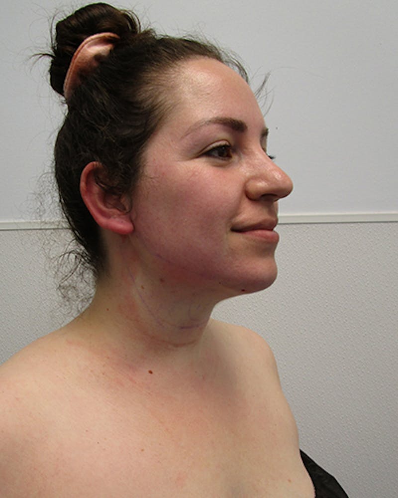 Neck Liposuction Before & After Gallery - Patient 219965 - Image 5