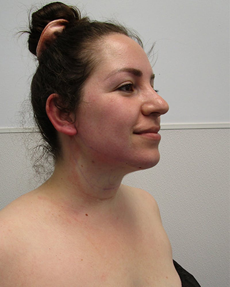 Neck Liposuction Before & After Gallery - Patient 219965 - Image 6