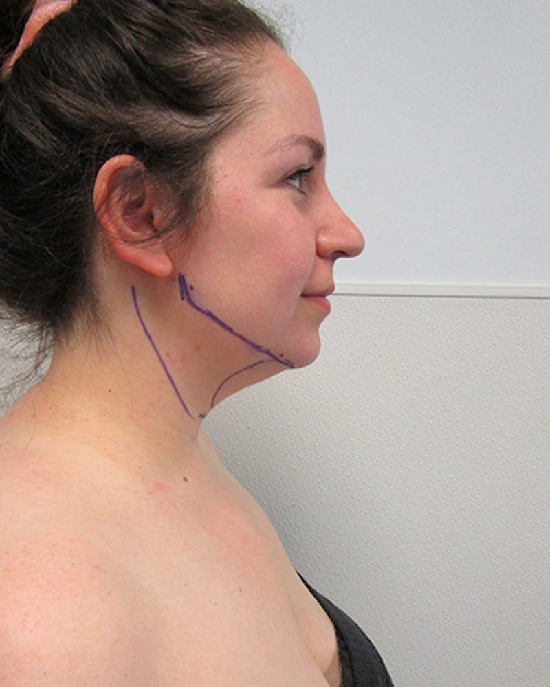 Neck Liposuction Before & After Gallery - Patient 219965 - Image 7
