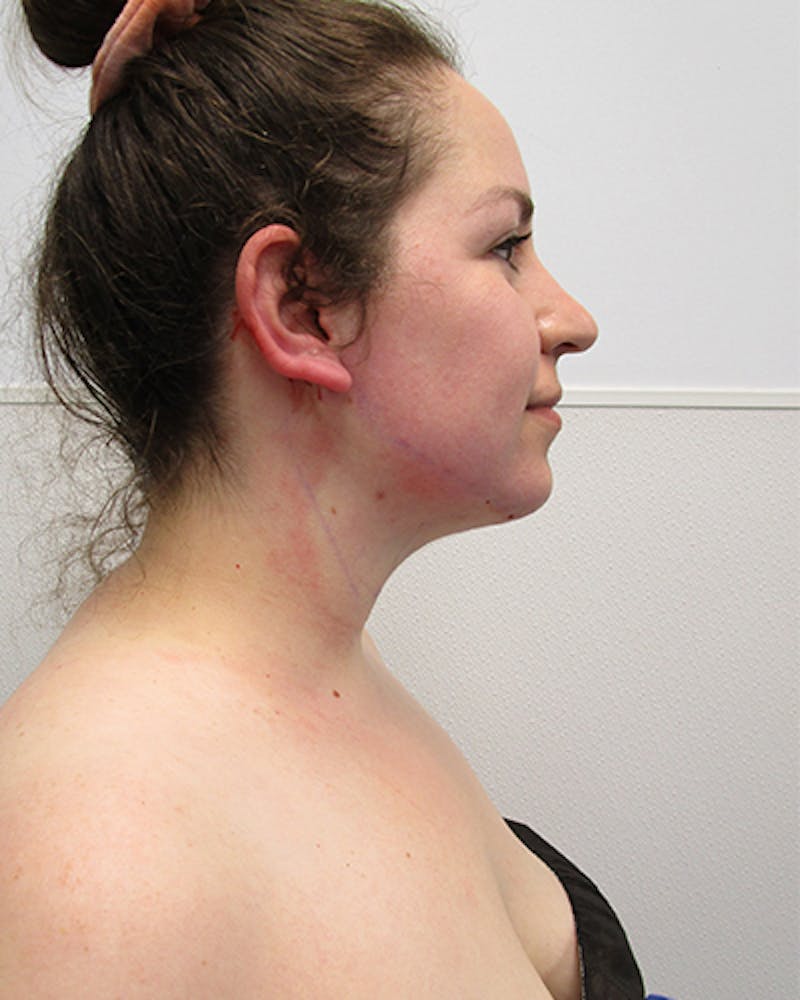Neck Liposuction Before & After Gallery - Patient 219965 - Image 8