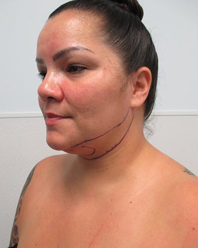 Neck Liposuction Before & After Gallery - Patient 812975 - Image 1