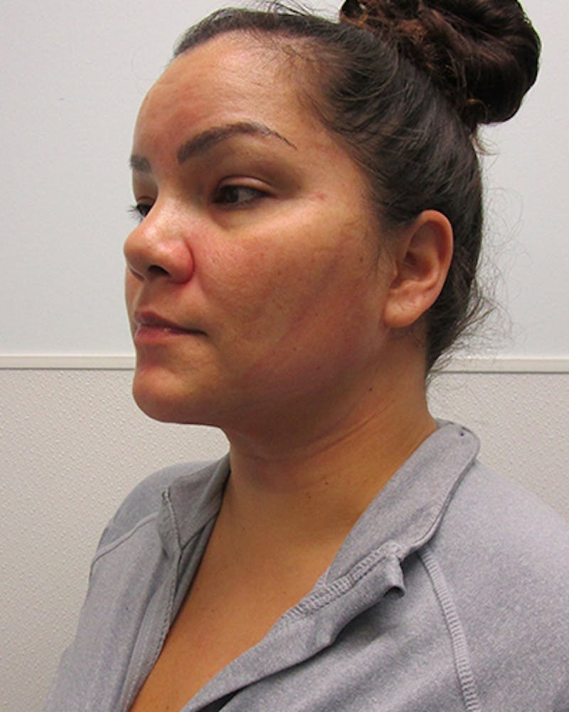 Neck Liposuction Before & After Gallery - Patient 812975 - Image 2