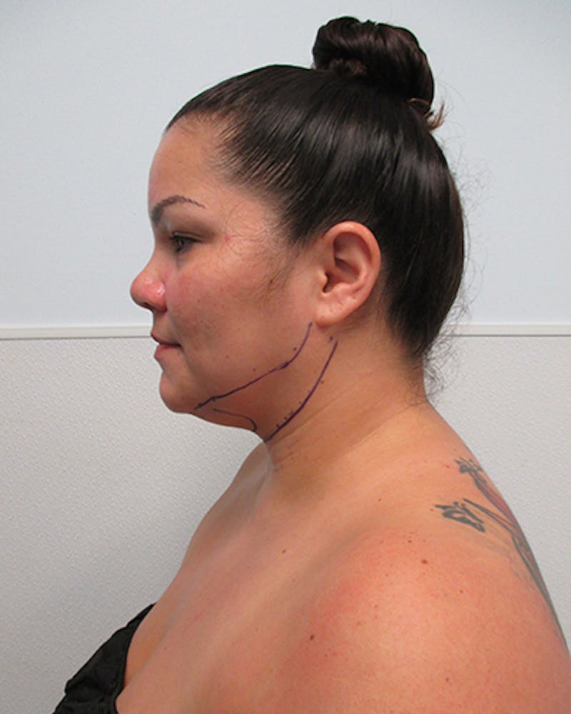 Neck Liposuction Before & After Gallery - Patient 812975 - Image 3