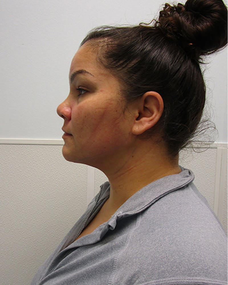 Neck Liposuction Before & After Gallery - Patient 812975 - Image 4