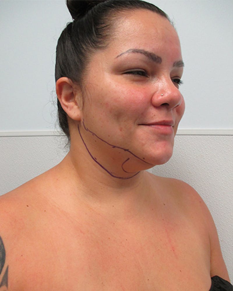 Neck Liposuction Before & After Gallery - Patient 812975 - Image 5