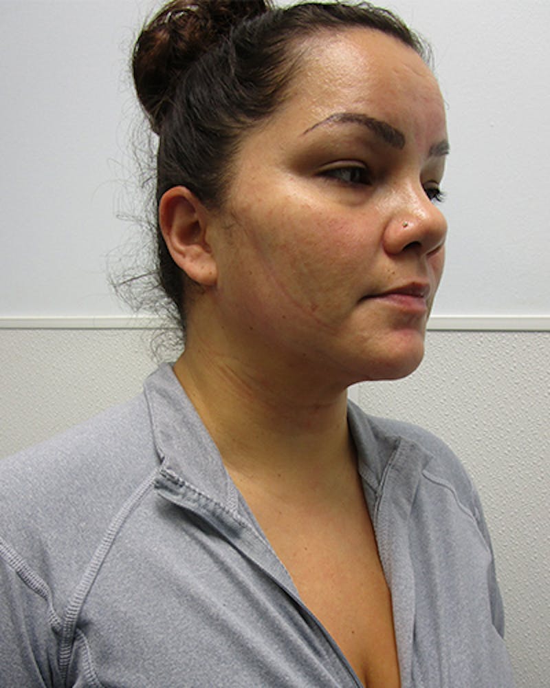Neck Liposuction Before & After Gallery - Patient 812975 - Image 6