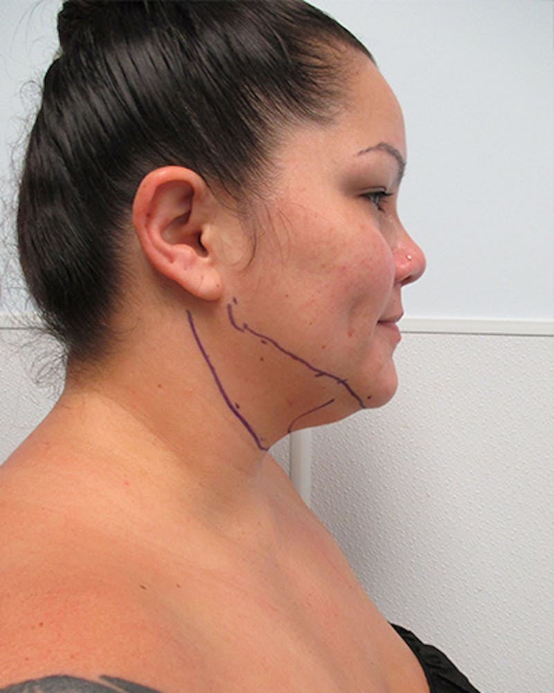 Neck Liposuction Before & After Gallery - Patient 812975 - Image 7