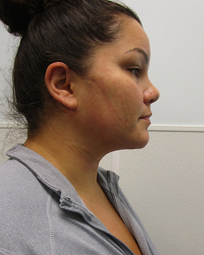 Neck Liposuction Before & After Gallery - Patient 812975 - Image 8