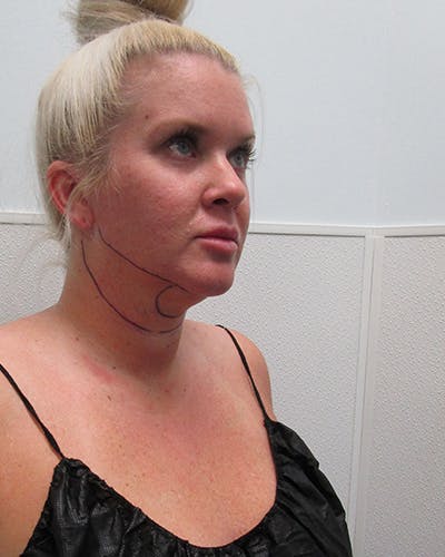 Neck Liposuction Before & After Gallery - Patient 281584 - Image 1
