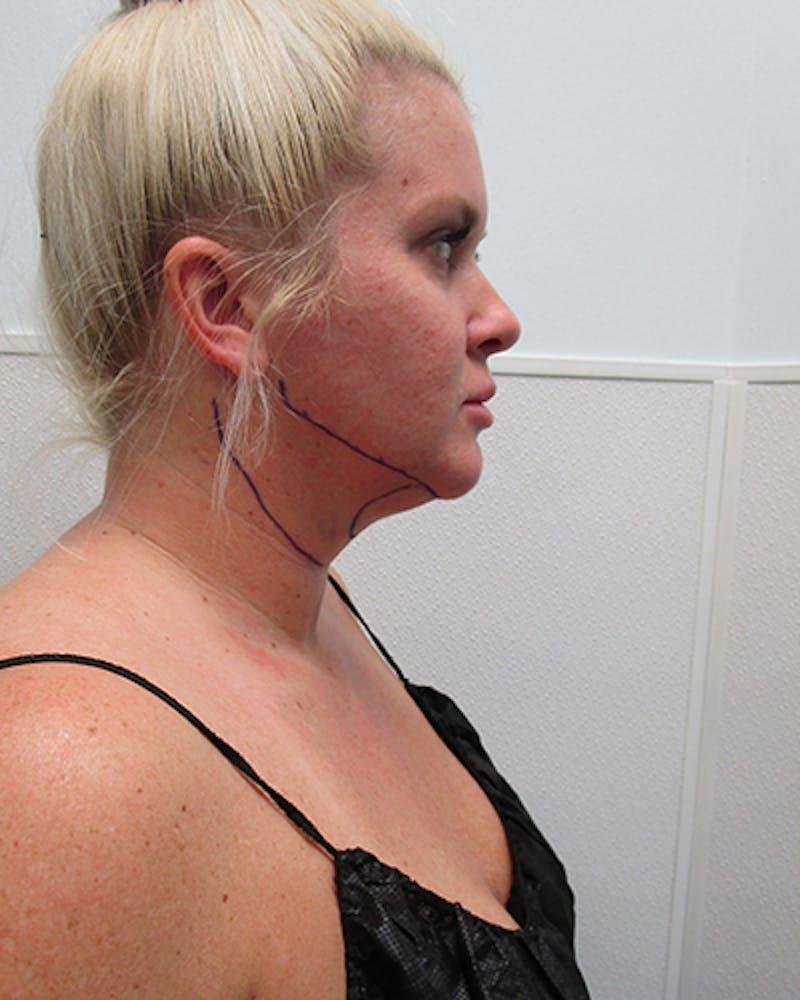 Neck Liposuction Before & After Gallery - Patient 281584 - Image 3