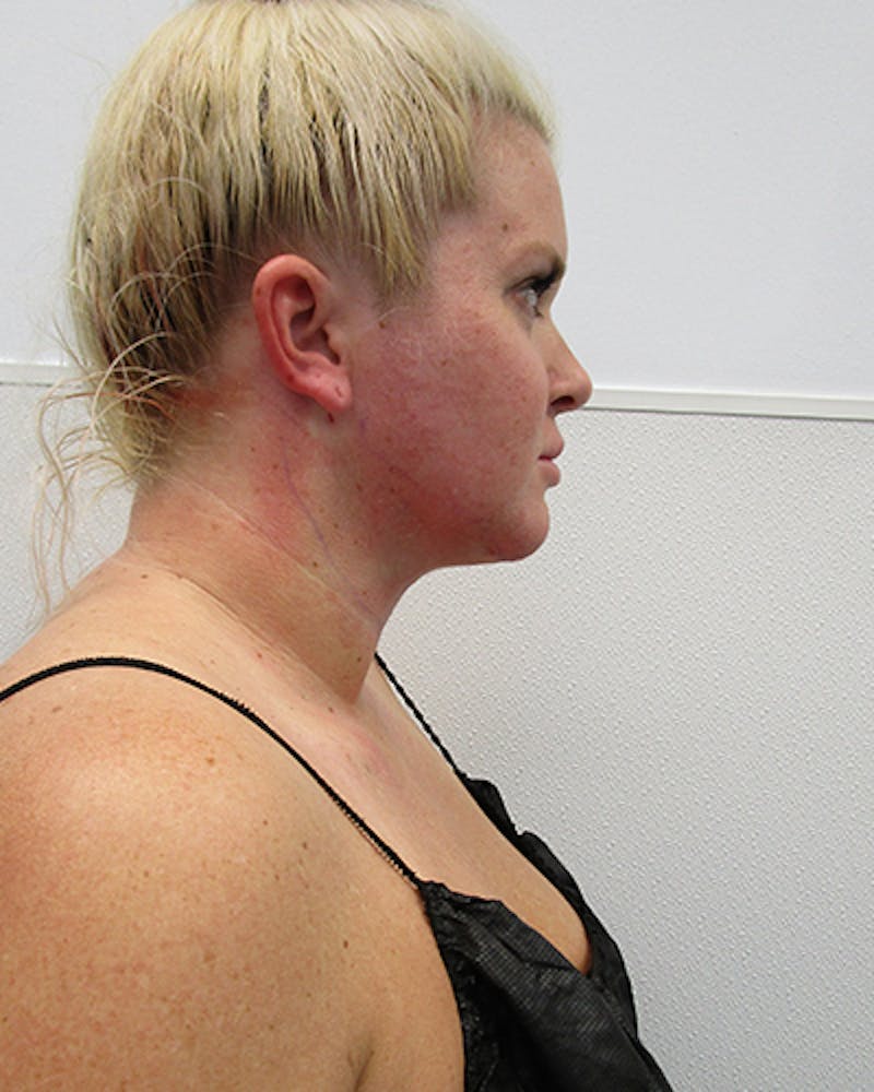 Neck Liposuction Before & After Gallery - Patient 281584 - Image 4