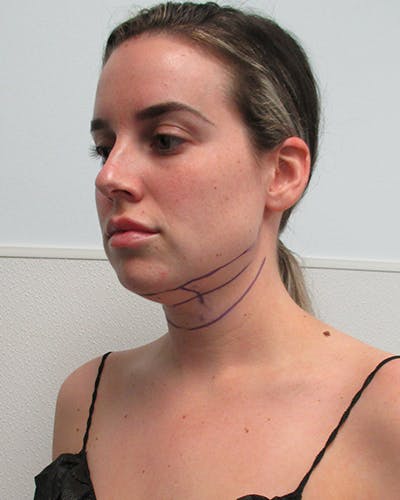 Neck Liposuction Before & After Gallery - Patient 379896 - Image 1