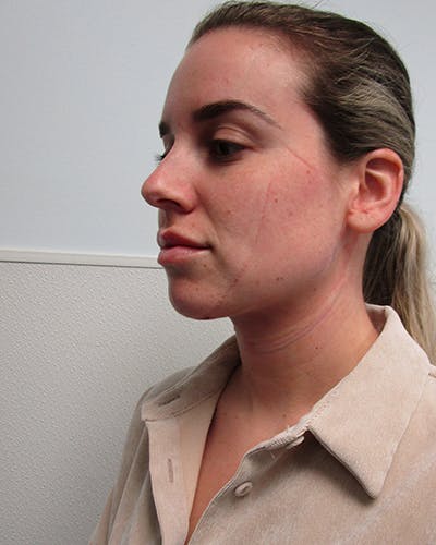Neck Liposuction Before & After Gallery - Patient 379896 - Image 2
