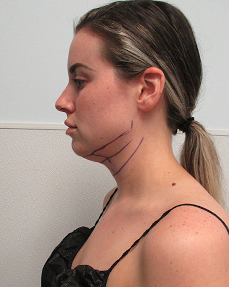 Neck Liposuction Before & After Gallery - Patient 379896 - Image 3