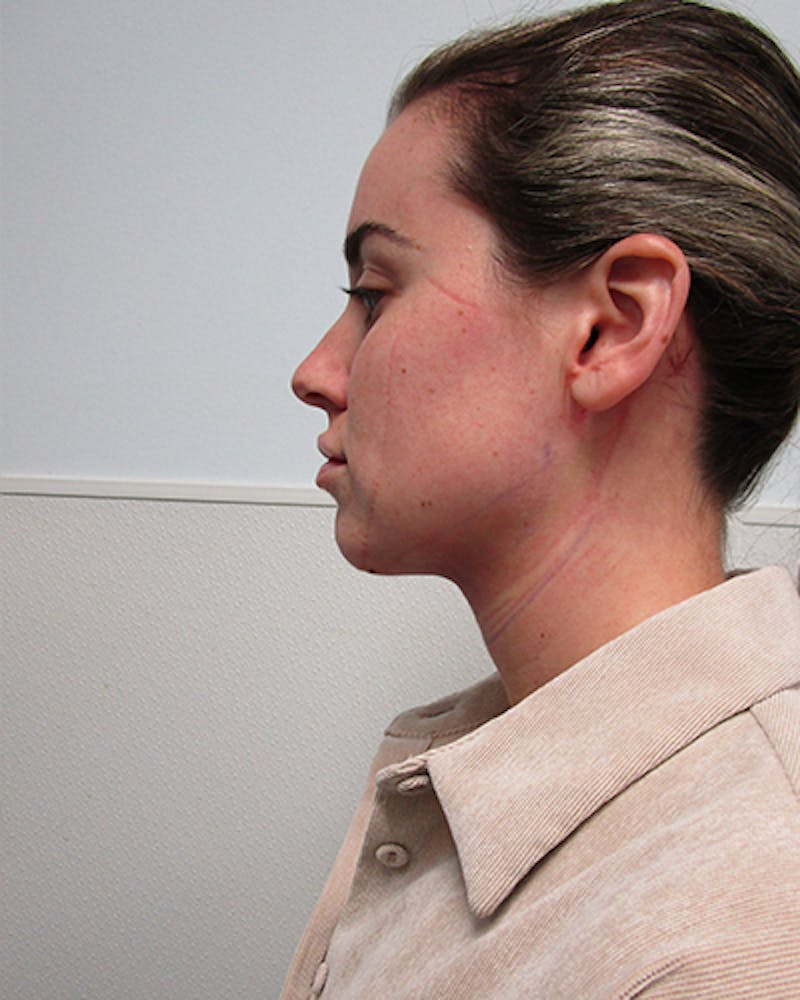 Neck Liposuction Before & After Gallery - Patient 379896 - Image 4