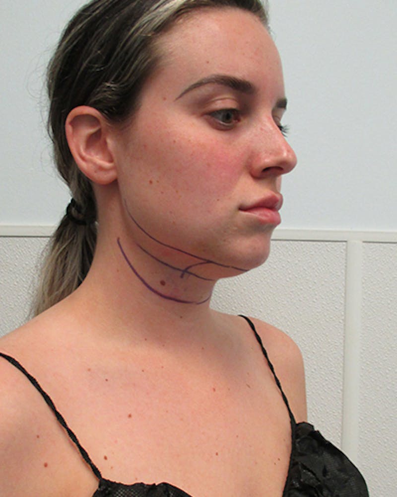 Neck Liposuction Before & After Gallery - Patient 379896 - Image 5