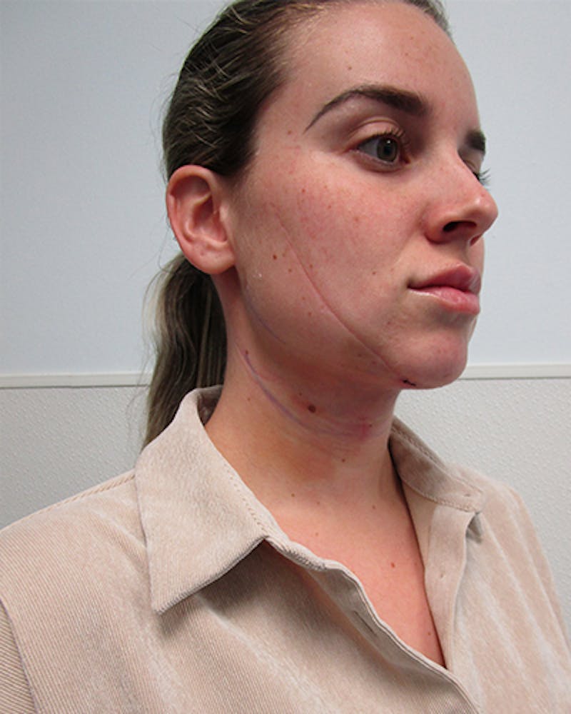 Neck Liposuction Before & After Gallery - Patient 379896 - Image 6