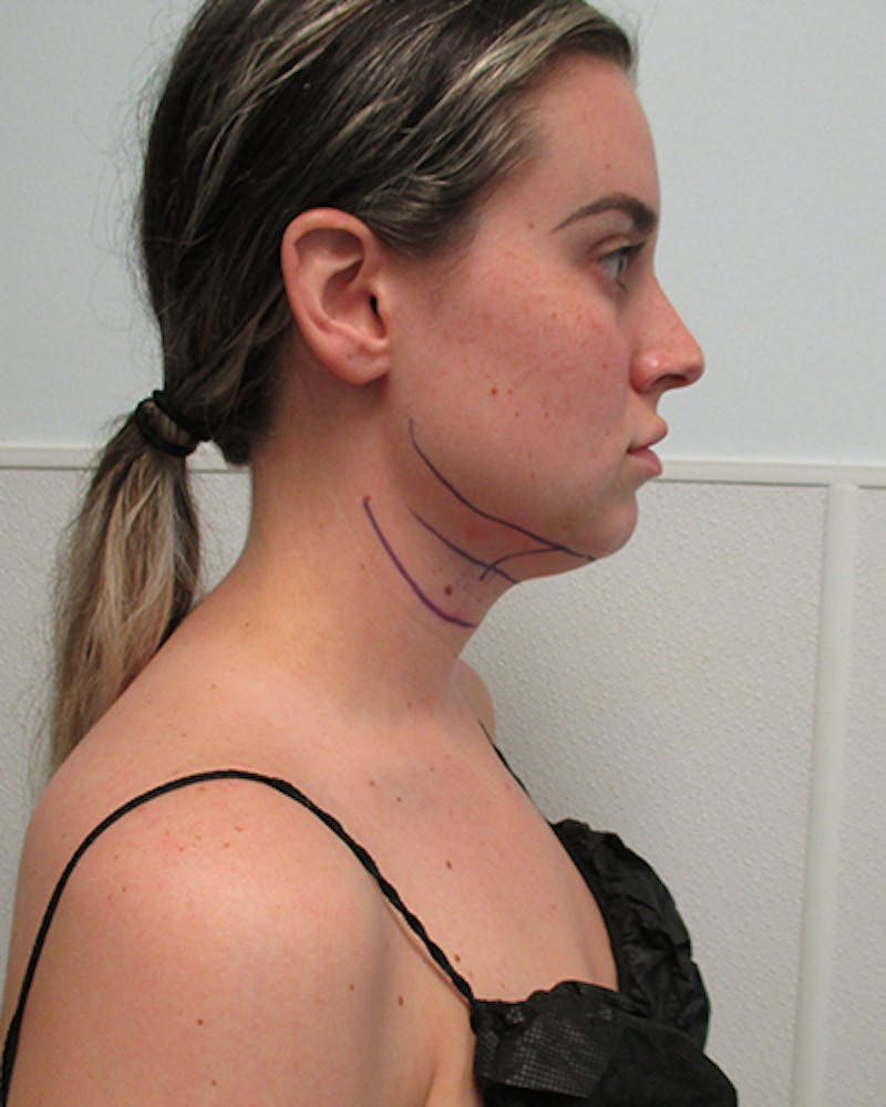 Neck Liposuction Before & After Gallery - Patient 379896 - Image 7