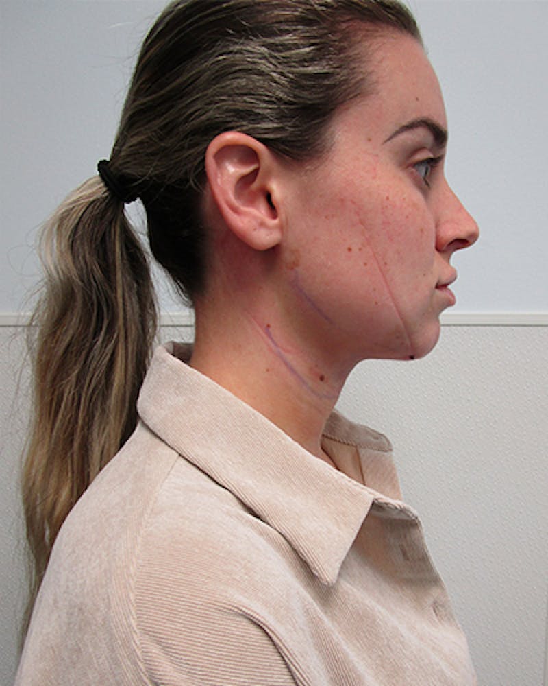 Neck Liposuction Before & After Gallery - Patient 379896 - Image 8