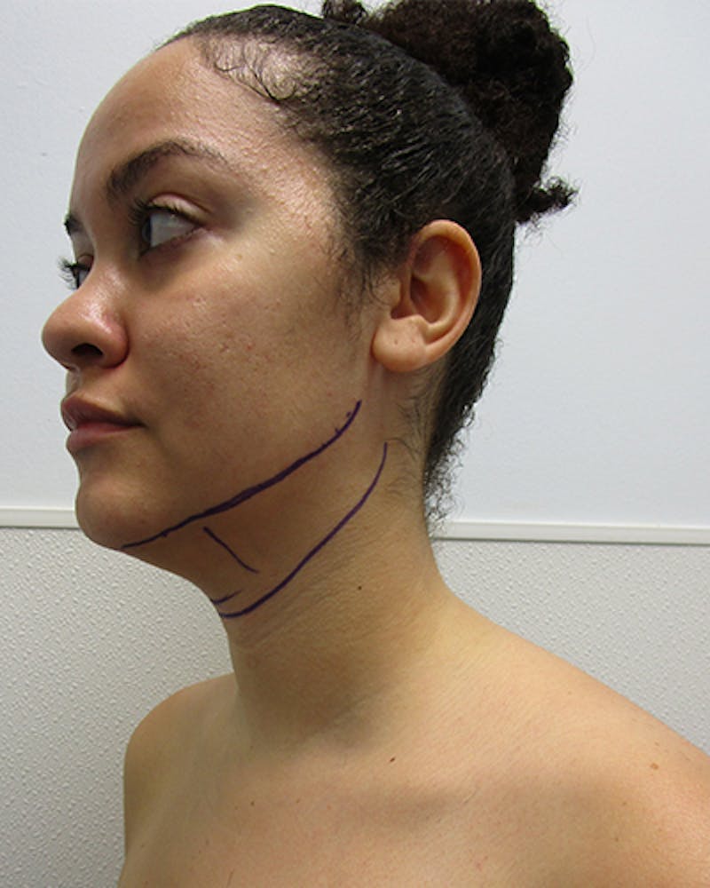 Neck Liposuction Before & After Gallery - Patient 332440 - Image 1