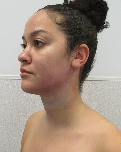 Neck Liposuction Before & After Gallery - Patient 332440 - Image 2
