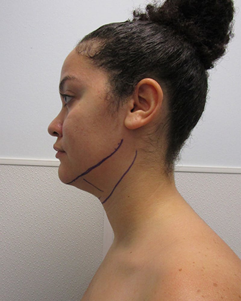 Neck Liposuction Before & After Gallery - Patient 332440 - Image 3