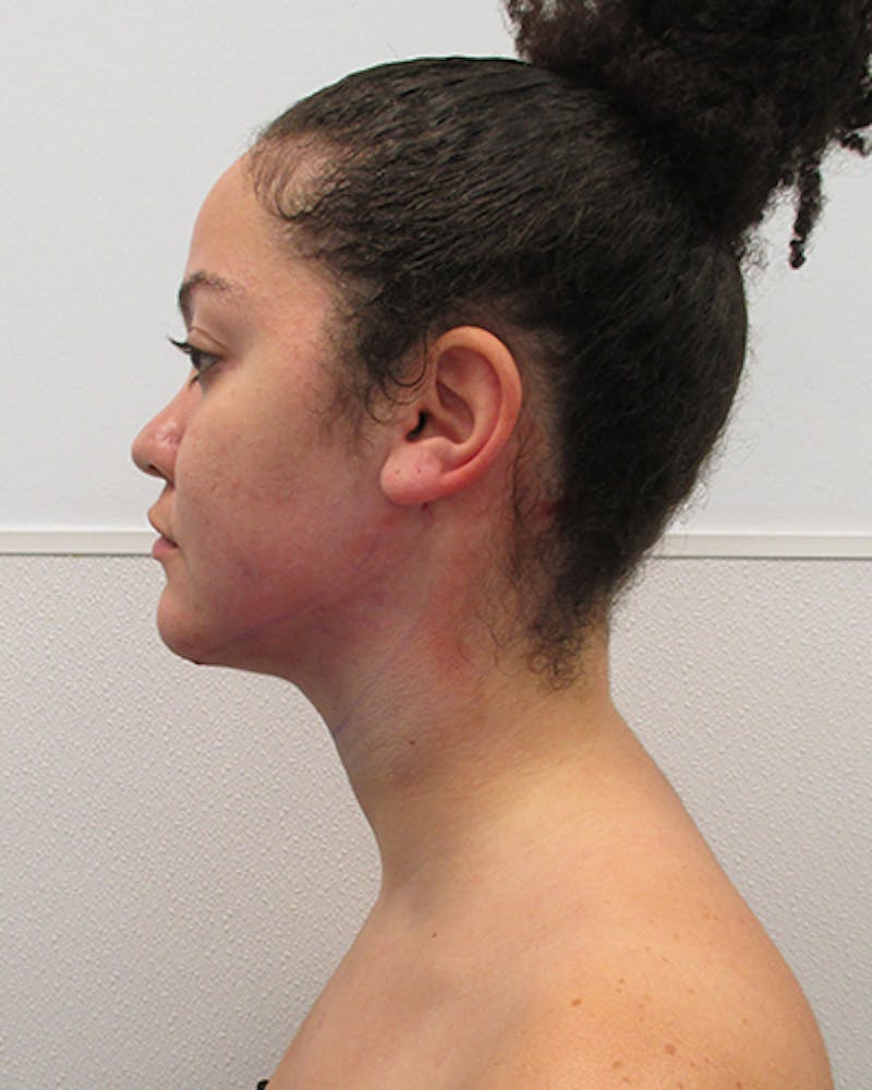 Neck Liposuction Before & After Gallery - Patient 332440 - Image 4