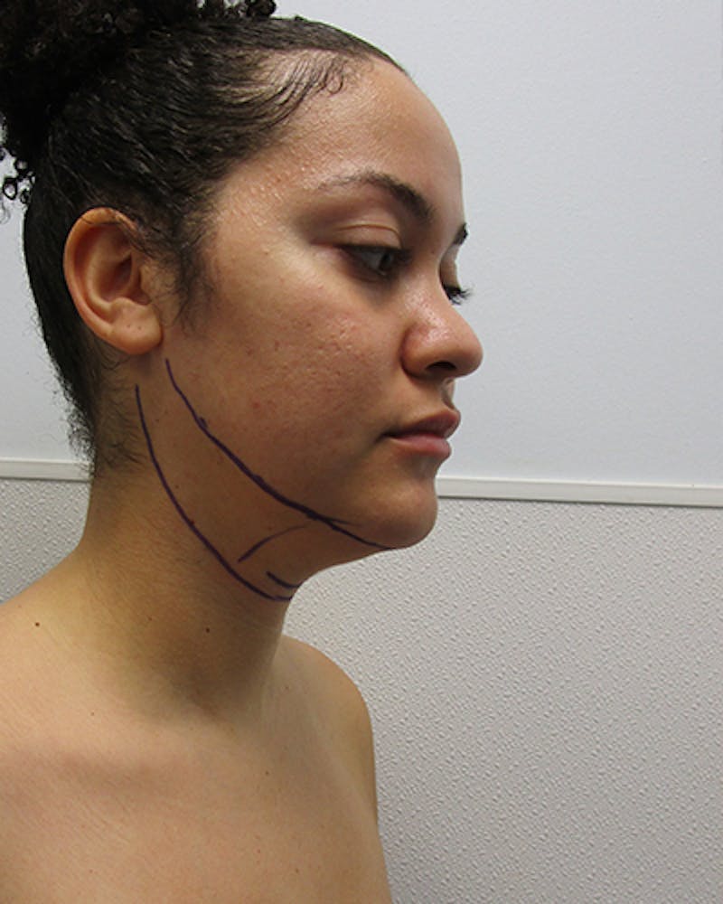 Neck Liposuction Before & After Gallery - Patient 332440 - Image 5