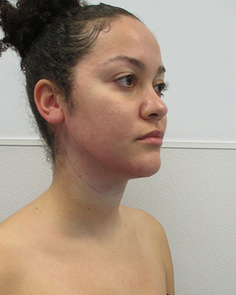 Neck Liposuction Before & After Gallery - Patient 332440 - Image 6