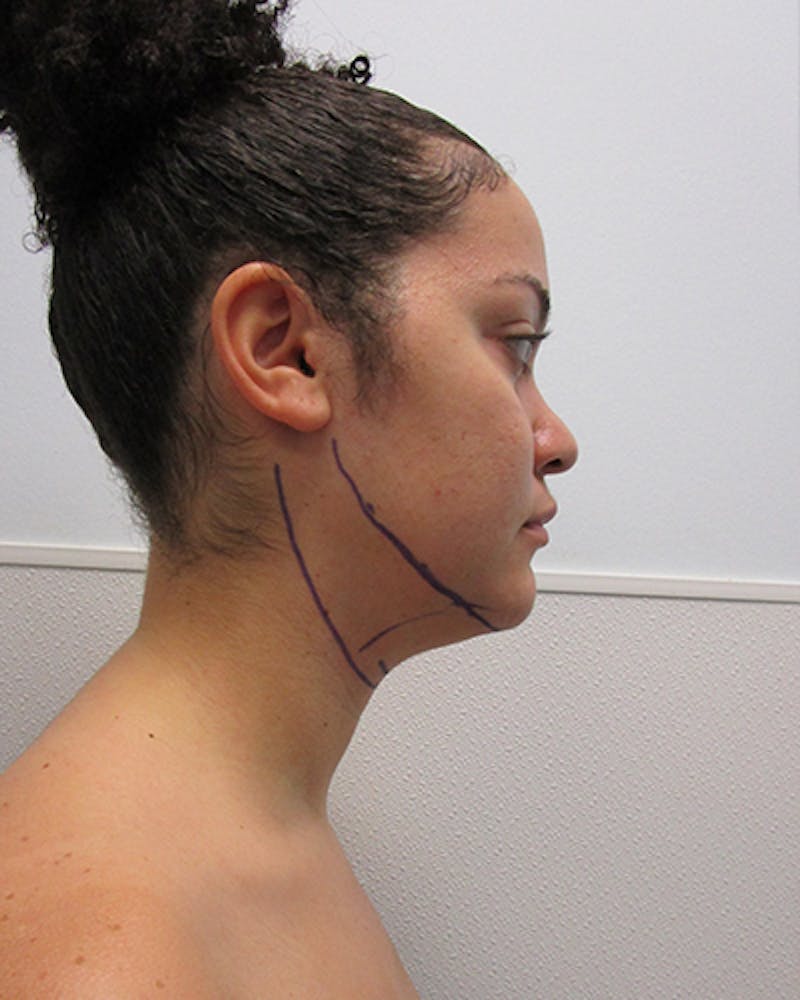 Neck Liposuction Before & After Gallery - Patient 332440 - Image 7