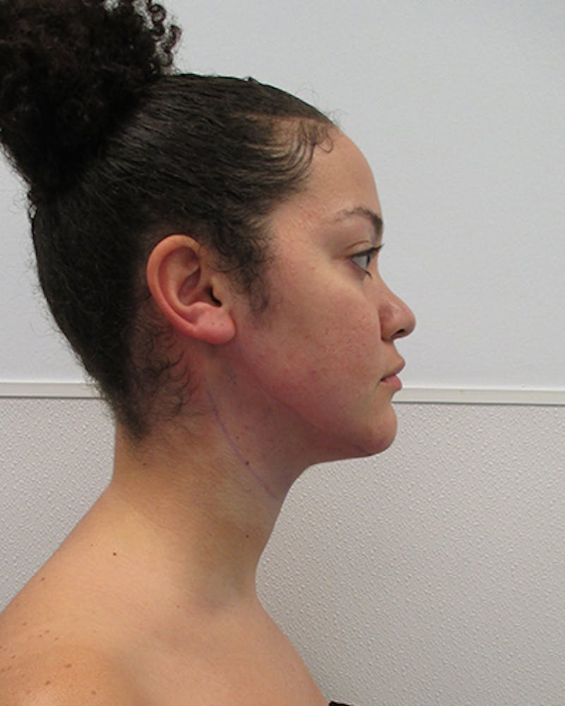 Neck Liposuction Before & After Gallery - Patient 332440 - Image 8