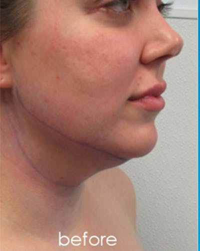 Neck Liposuction Before & After Gallery - Patient 359379 - Image 1