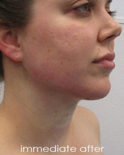 Neck Liposuction Before & After Gallery - Patient 359379 - Image 2