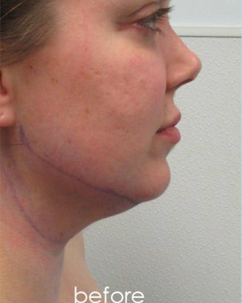 Neck Liposuction Before & After Gallery - Patient 359379 - Image 3