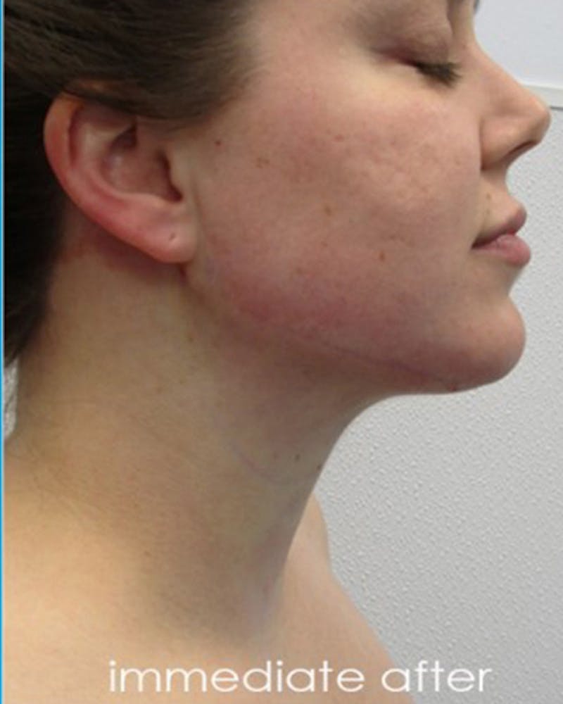 Neck Liposuction Before & After Gallery - Patient 359379 - Image 4