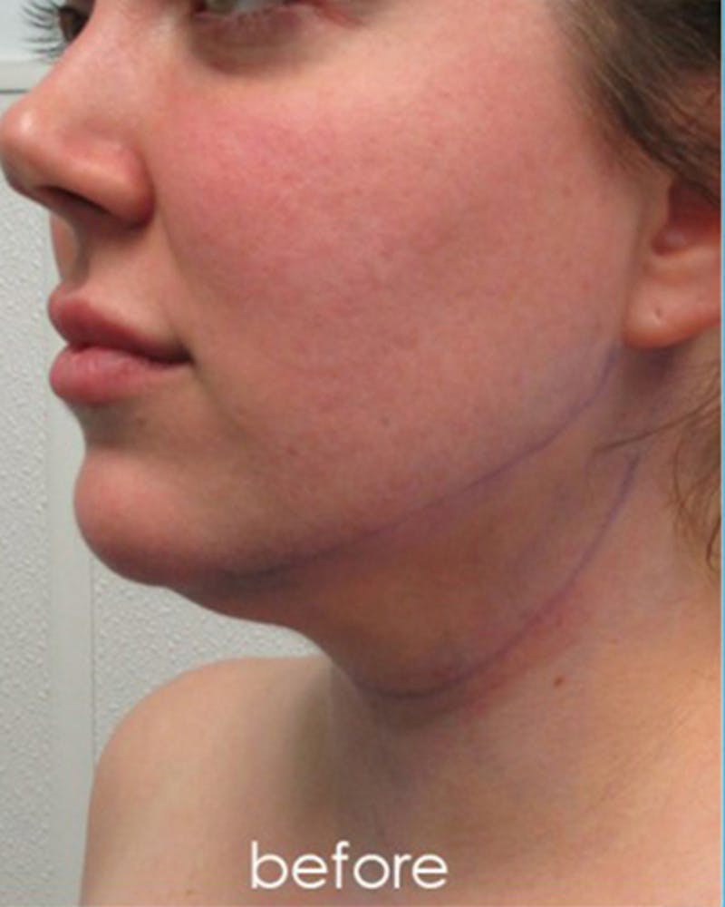 Neck Liposuction Before & After Gallery - Patient 359379 - Image 5