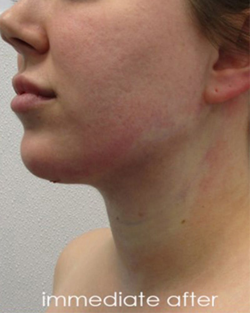 Neck Liposuction Before & After Gallery - Patient 359379 - Image 6