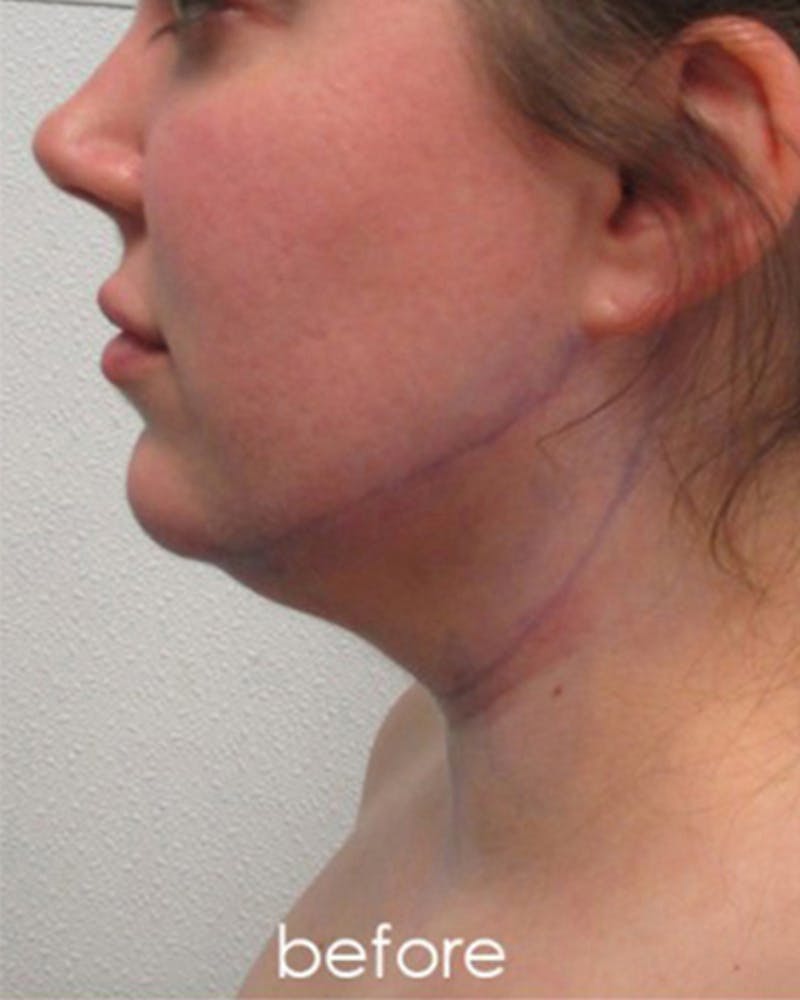 Neck Liposuction Before & After Gallery - Patient 359379 - Image 7