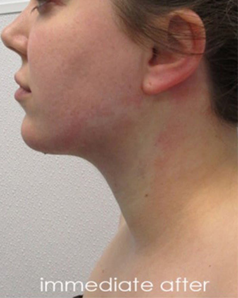 Neck Liposuction Before & After Gallery - Patient 359379 - Image 8