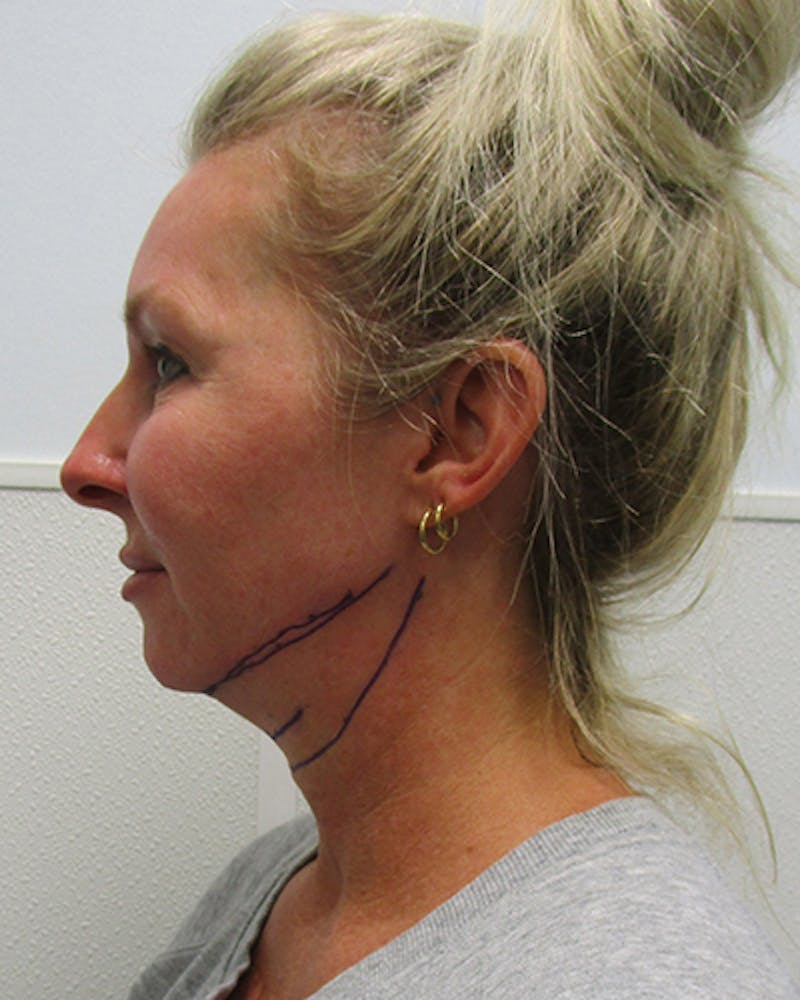 Neck Liposuction Before & After Gallery - Patient 489145 - Image 1