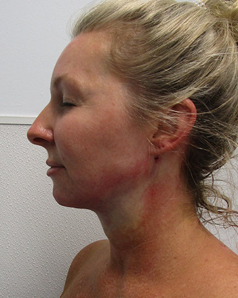 Neck Liposuction Before & After Gallery - Patient 489145 - Image 2