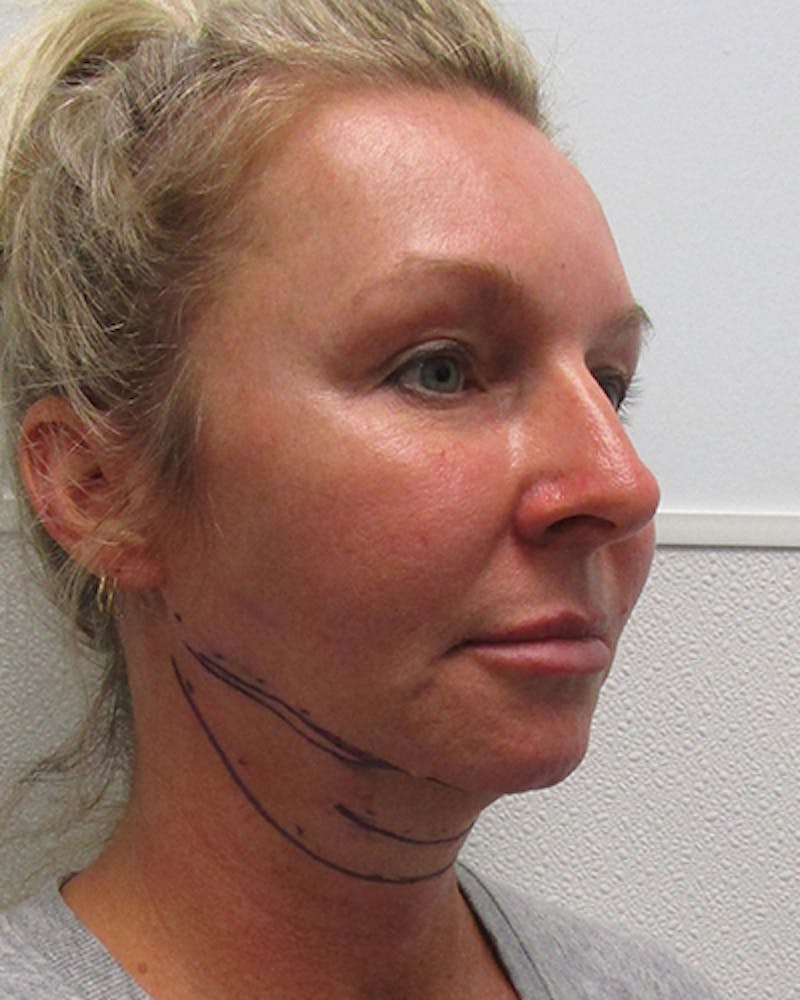 Neck Liposuction Before & After Gallery - Patient 489145 - Image 3
