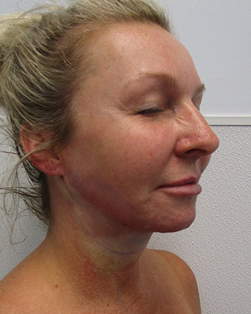 Neck Liposuction Before & After Gallery - Patient 489145 - Image 4