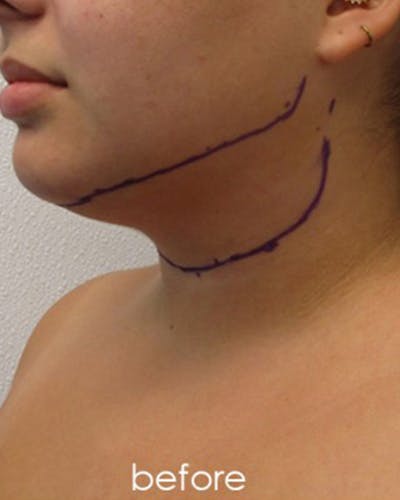 Neck Liposuction Before & After Gallery - Patient 109692 - Image 1