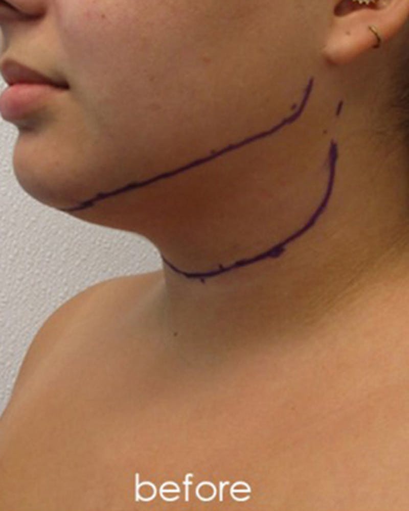 Neck Liposuction Before & After Gallery - Patient 109692 - Image 1