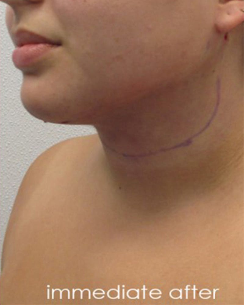 Neck Liposuction Before & After Gallery - Patient 109692 - Image 2