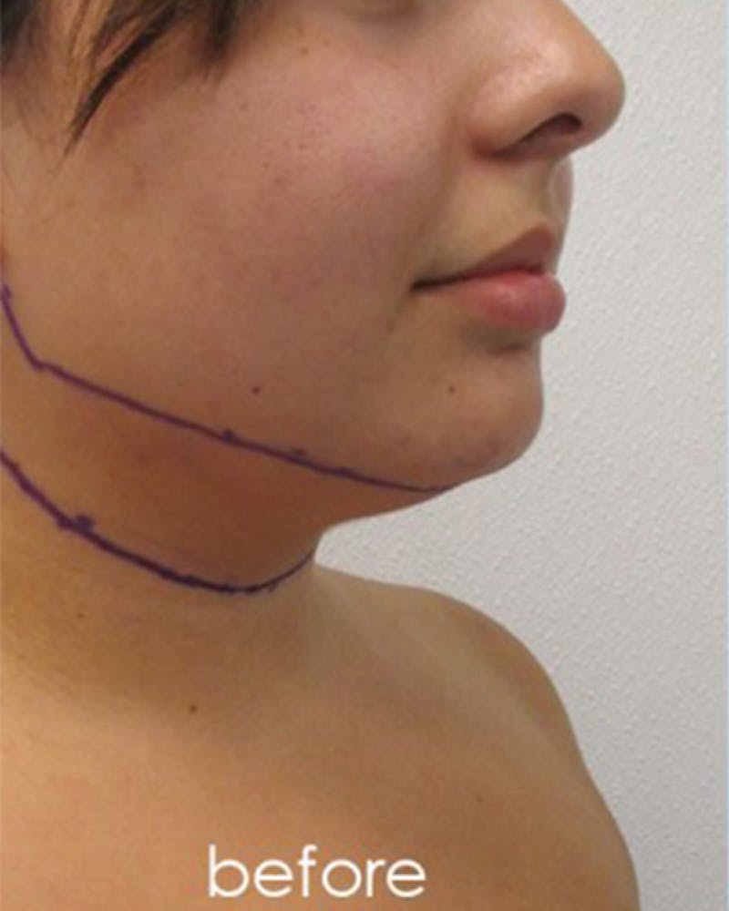 Neck Liposuction Before & After Gallery - Patient 109692 - Image 3